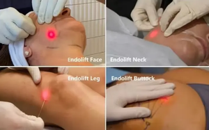 Láser Facial Endolaser 980 1470nm Lipo anticelulítico lipólisis diodo láser Estiramiento facial estiramiento de la piel máquina de liposucción de barbilla - Product Image 4