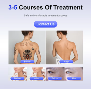 Picosecond Nd Yag 2025/532/1064nm 3 mesin gelombang, perangkat penghilang tato Laser Korea tanpa rasa sakit 755 - Product Image 5
