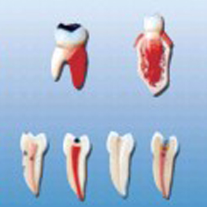 Ada โมเดลทางการแพทย์เกี่ยวกับโรคเยื่อทางทันตกรรมและแบบจำลองชุดรอยโรคฟันสำหรับการสาธิตโรคเครื่องมือการสอนทางการแพทย์ - Product Image 4