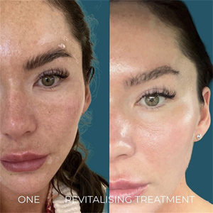 Kit de Biomicroneedling GZ aux Spicules de Spongilla, <span class=keywords><strong>Bio</strong></span> Peeling Cutané Non Chimique, Bioneedling Sûr pour Tous Types de Peaux, Kit de Peeling Cutané - Product Image 4
