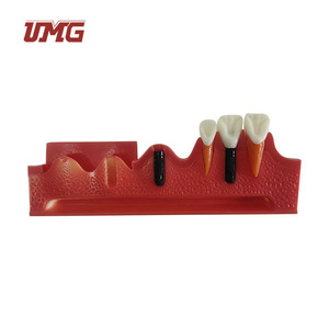 Modelo Dental Seccionado de Implantes, Material de Resina, Marca UMG con Certificación CE para Prácticas Estudiantiles - Product Image 1
