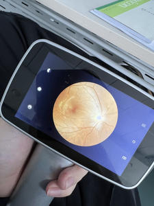 กล้องเรติน่าแบบมือถืออุปกรณ์ด้านจักษุวิทยา - Product Image 6