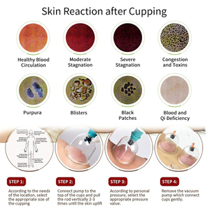 Traditionelle chinesische medizinische Geräte Hijama Schröpfen Tasse ABC Marke Schröpfen Tasse Set - Product Image 5