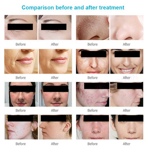 Appareil de soin du visage professionnel 7 <span class=keywords><strong>en</strong></span> 1 2024, microdermabrasion, oxygénation, machine à oxygène pour le visage - Product Image 3