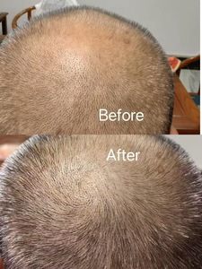 Ripristino dei capelli esozomi potente soluzione di ricrescita Kit per la crescita dei capelli riparazione delle radici del cuoio capelluto EGF cellule staminali vegetali B - Product Image 6