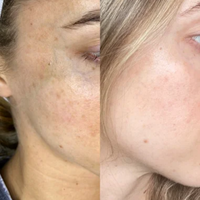 Sérum Resurfaçant Multi-Acides + Complexe Tri-Enzymes, Peeling Enzymatique Exfoliant, Thérapie de Polissage de la Peau du Visage, Peeling Professionnel pour Salon