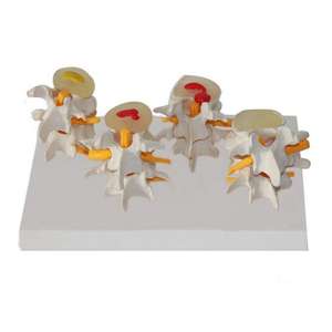Gelsonlab HSBM-134 4 Stadiumwervels Menselijk Anatomisch Model Lendenwervel Wervel Zieke Osteoporose Wervels Model - Product Image 3