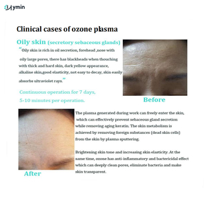 2025s portable oxygène traitement de l'acné du visage nettoyage Jet <span class=keywords><strong>Plasma</strong></span> Skin Lift Ozone Cold <span class=keywords><strong>Plasma</strong></span> Pen - Product Image 3