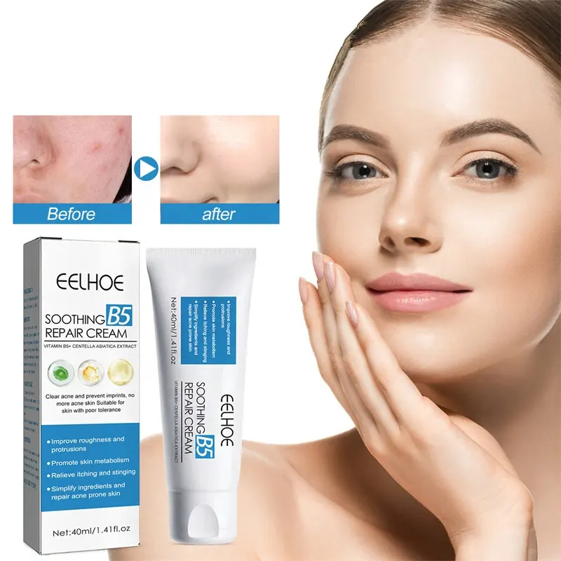 Eelhoe Anti Acne B5 Kalmerende Reparatie Gezichtscrème Mee-Eter Verwijderen Poriën Krimpende Acne Verwijderingscrème Voor Gezicht