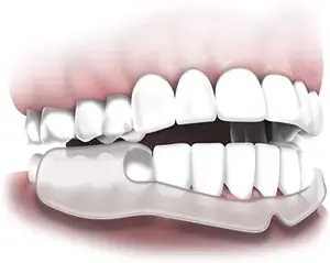 לטחון אין יותר שיניים לילה משמר OPP תיק CE מגן שיניים הלבנת נחירות שופר