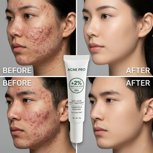 Gel Traitant Anti-Acné à Absorption Rapide, Éliminateur de Boutons, Nettoyant Points Noirs, Réducteur de Pores Dilatés, Atténuateur de Cicatrices d'Acné, <span class=keywords><strong>Correcteur</strong></span> de Taches Brunes - Product Image 1