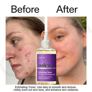 Oalen Private Label Facial Exfoliating Toner Daily Brightening Treatment Reduces Uneven <strong>Marks</strong> for Nice Skin Tone - Product Image 2