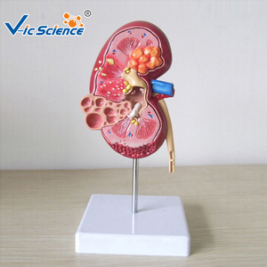 Modelo Anatómico de Riñón con Quiste Renal, Modelo de Anatomía Humana para Enseñanza Médica, Equipo de Patología Renal para Modelo de Quiste Renal - Product Image 1