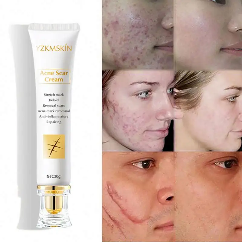 Reparación de la piel del cuerpo de la cara de alta calidad reduce las estrías Reparación de cicatrices de quemaduras Crema de eliminación de cicatrices de acné Crema de eliminación de cicatrices
