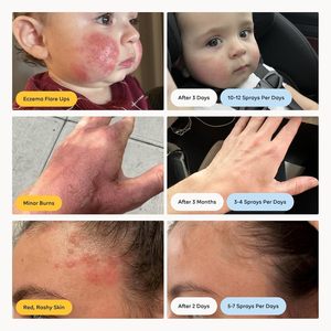 สเปรย์กรดไฮโปคลอไรซ์ ช่วยรักษาสิว ผื่นคัน และผื่นแพ้ ผสมกรดซาลิไซลิก 2% และน้ำมันทีทรี สเปรย์กำจัดสิว - Product Image 3