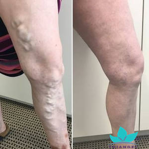 शीर्ष बिक्री प्रमाणीकरण 980nm + 1470nm एंडोवेनस वैरिकाज़ नसों डायोड लेजर एब्लेशन/इवेला हटाने वैरिकाज़ मशीन - Product Image 5