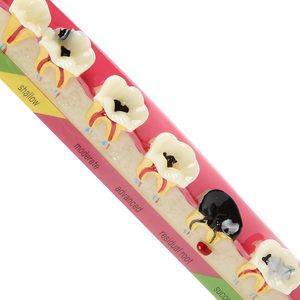 Dental <b>Teeth</b> Model 6-Stage Caries Development Educational Model for Periodontal Disease Patient Display - Product Image 6