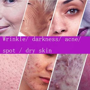 1000G Acne-Porne Gezichtscrème Bleekcrème Voor Donkere Huidvlekkenverwijderaar Private Label - Product Image 5