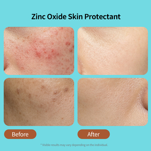 <span class=keywords><strong>Crème</strong></span> <span class=keywords><strong>Visage</strong></span> à l'Oxyde de Zinc OEM/ODM : Répare, Apaise l'Acné et les Rougeurs, Renforce la Barrière Cutanée, Hydratante, Non Comédogène – Soin Coréen - Product Image 4