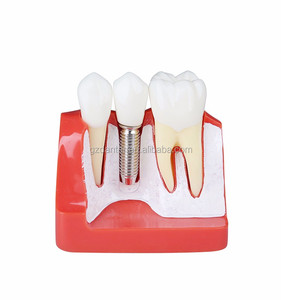 4 volte la scienza medica impianto dentale modello porcellana denti amovibile corona ponte impiallacciature per l'insegnamento di materiale plastico - Product Image 1