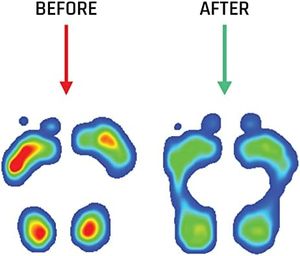 Metatarsal Insoles Pain Relief <strong>Plantar</strong> <strong>Fasciitis</strong> Arch Support Cushioned Foot Care Insoles <strong>for</strong> <strong>Shoes</strong> <strong>Men</strong> Women - Product Image 4