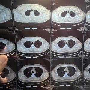 Pellicola Medica Termica a Getto d'Inchiostro Laser Blu e Bianca, Pellicola CT 8x10, 14x17 Pollici, Rotolo Medico Durevole CLEAR - Product Image 5