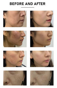 Meilleures ventes 2026 : Machine Thulium 1927nm/1550nm pour l'élimination des cicatrices d'acné, la régénération cutanée, l'élimination des vergetures, le resserrement vaginal et le nettoyage du <span class=keywords><strong>visage</strong></span> - Product Image 6