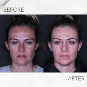 Système laser CO2 60W pour le rajeunissement de la peau Récupération des vergetures Resserrement vaginal Non invasif pour la santé intime des femmes - Product Image 6