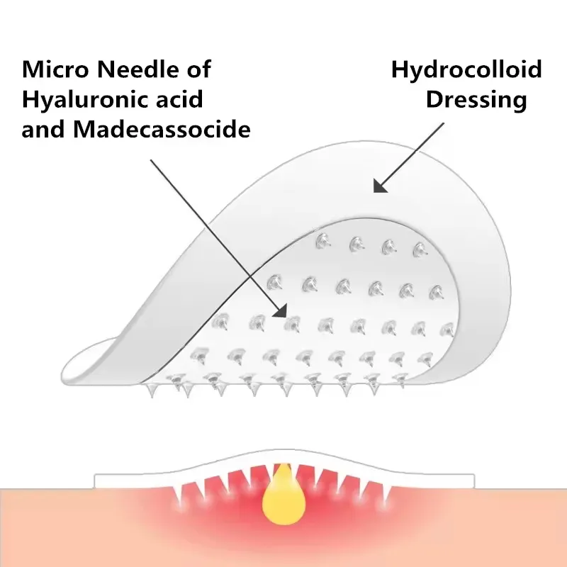 Oem Salicylvormige Micro-Acne Patch Microdart Micro-Dart Puistje Patch Micronaaldle Hydrocolloïde Acne Patch Voor Vlekken