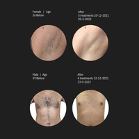 Épilation au laser diode médicale CE Alexander Esthétique 1600W avec longueurs d'onde 808nm/755nm Système de refroidissement triple