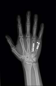 17*17 pouces Gos filaire numérique X Ray détecteur de défauts à écran plat équipement de radiologie et accessoire pour machine à rayons X humaine - Product Image 4