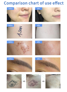 เครื่องลบรอยสักออลอินวัน 1064nm 755nm สำหรับล้างคิ้ว ใช้ได้กับใบหน้าและร่างกาย เหมาะสำหรับร้านเสริมสวย - Product Image 5