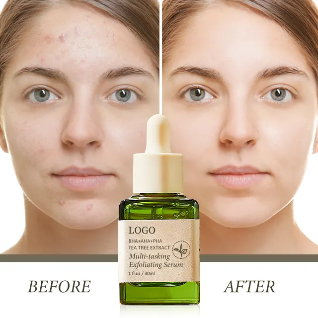 Bán Buôn 30 Ml Salicylic Axit Trên Khuôn Mặt Huyết Thanh Làm Sạch Chống-Mụn Trứng Cá Mặt Tẩy Tế Bào Chết Aha Huyết Thanh Nhãn Hiệu Riêng Cho Chăm Sóc Da