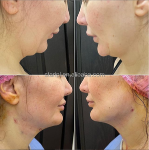 Láser de diodo endovenoso de 1470nm, máquina de liposucción de 980nm, dispositivo de belleza <span class=keywords><strong>Vaser</strong></span> para eliminar grasa corporal, cirugía de lipólisis, lifting endovenoso con láser - Product Image 3