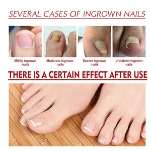 Renouvellement des ongles Extra Force Fungus Toe Fingails Repair Liquid Renew Endommagé Cassé Nail 7 Days Nail Fungus Treatment - Product Image 3