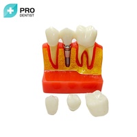 Modèle de développement de caries dentaires, modèle de dents dentaires pour l'étude de l'anatomie des dents dentaires, éducation médecin-patient et soins bucco-dentaires