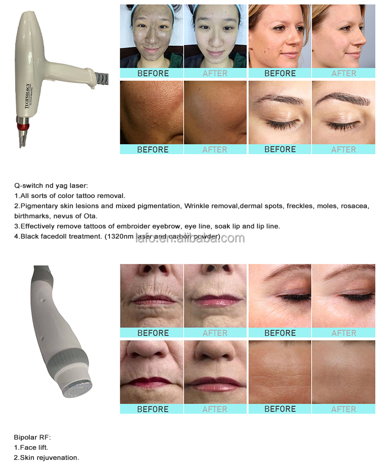 LAFO 4 In 1 OPT + IPL+ Rf+ Nd YAG Permanent hair removal laser Tattoo Removal Skin Rejuvenation beauty machine 4 handles