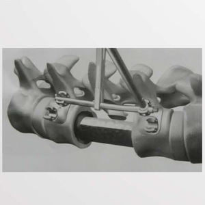 Orthopedische <span class=keywords><strong>Implant</strong></span> Titanium Mesh Met Anterior Platen Cilindrische Interbody Fusion Kooi Prismatische Gat - Product Image 5