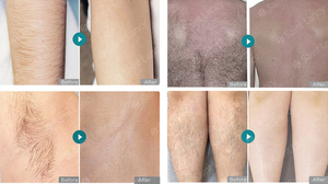 <span class=keywords><strong>CE</strong></span> Được Phê Duyệt Đa Chức Năng Máy Làm Đẹp Elight + Diode 808nm Laser + Q Chuyển Nd Yag Laser + <span class=keywords><strong>RF</strong></span> - Product Image 5