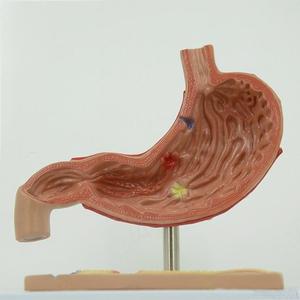 Modèle pathologique d'estomac en 2 parties - Démonstration de la transition de la gastrite à la perforation pour l'enseignement en gastroentérologie - Product Image 2