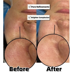 Suero Exfoliante con Triple Enzima, Papain, Bromelina y Superóxido Dismutasa, Terapia Enzimática Bio Proteasa para Lifting Facial - Product Image 2