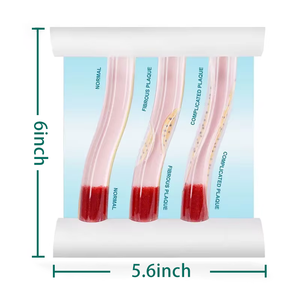 Comparaison de démonstration du flux de cohérence sanguine dans le PVC Modèle de blocage dynamique des vaisseaux de l'hyperlipidémie humaine pour la science médicale - Product Image 3