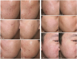 1550 &amp; 1927 Nm Dual Wave Thulium <strong>Laser</strong> For Melasma <strong>Laser</strong> 1927 1550 Erbium Thulium Micro Ablative 1550 &amp; 1927 Non Ablative <strong>Laser</strong> - Product Image 5