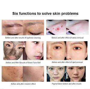 Laser professionnel à 4 longueurs d'onde de qualité salon pour le tatouage et l'élimination des pigments - Product Image 5