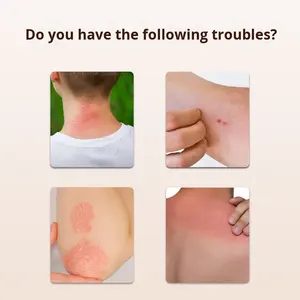 Pomada para aliviar <span class=keywords><strong>la</strong></span> picazón de <span class=keywords><strong>la</strong></span> piel, eccema alérgico <span class=keywords><strong>en</strong></span> manos y pies y picaduras de mosquitos - Product Image 3