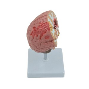 Modèle de <span class=keywords><strong>pathologie</strong></span> du cerveau humain avec hémorragie et malformation <span class=keywords><strong>vasculaire</strong></span> pour l'enseignement de l'anatomie - Product Image 3