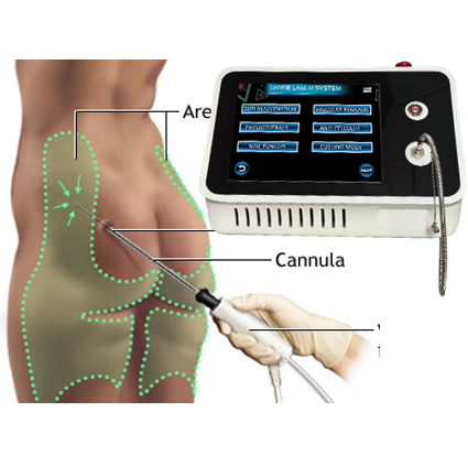 Endolaser Vet Lipolyse Machine 980nm Diode Laser Liposuctie Canule 1470nm Fiber Laser Body Countring Face Lifting Spa Optic