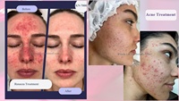 Appareil de luminothérapie LED médical pour la récupération post-traitement, laser PRP, microneedling, Kernel KN-7000A, rouge, bleu, jaune, infrarouge