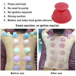 Set Bekam Terapi Akupuntur, Bekam Silikon Portabel - Product Image 6