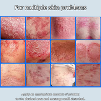 Vente en gros Soins privés Pommade pour l'eczéma Pommade bactériostatique pour la peau du corps à base de plantes anti-démangeaisons